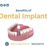 Benefits-of Dental-Implants