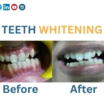 TEETH-WHITENING