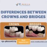 Dental-Crown-and-Bridges