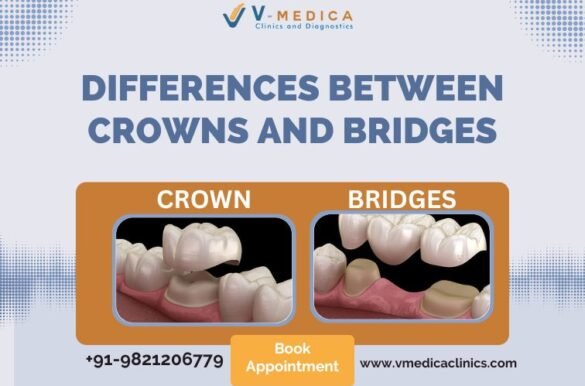 Dental-Crown-and-Bridges